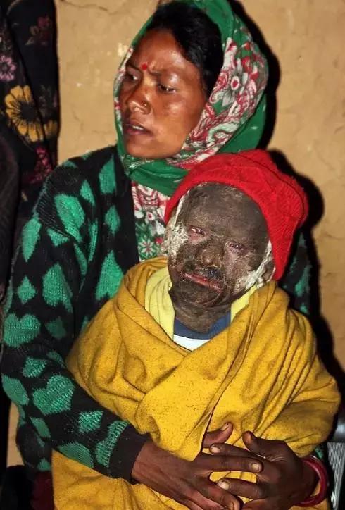 印度男孩身上长满了什么,印度11岁男孩长满鳞片