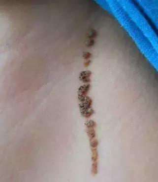 宝宝身上有5个胎记,孩子身上有10块胎记