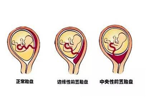 前壁胎盘≠前置胎盘，如果有揪心的胎盘低置或前置胎盘，怎么办？