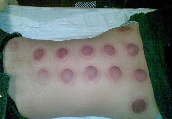 拔罐后不同位置罐印颜色不同,拔罐出现罐斑的原理