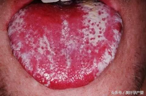 宝宝鹅口疮吃什么药不复发,宝宝怎么预防不长鹅口疮