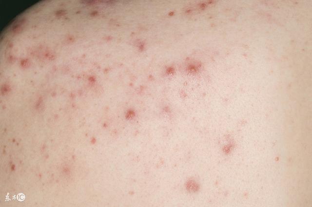 丘疹怎么护理才好得快,丘疹有什么危险