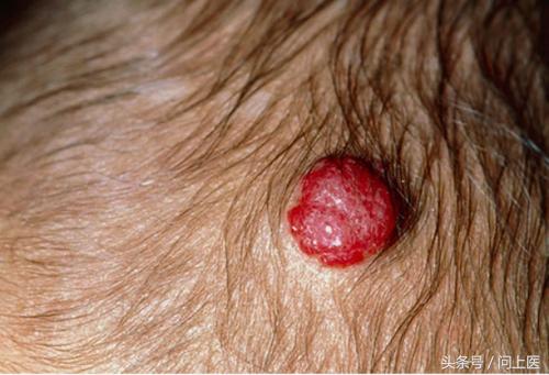 你有胎记吗？图解8种常见胎记