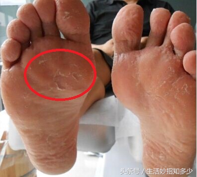 手脚脱皮有什么特效药吗,手脚脱皮怎么不用药