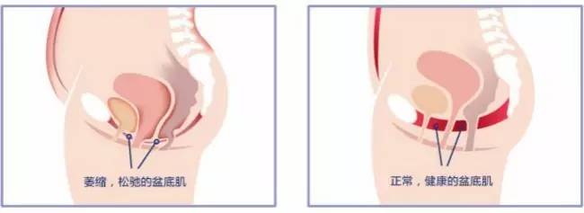 生完小孩一年打个喷嚏就漏尿,打个喷嚏漏尿需要做盆底肌修复吗