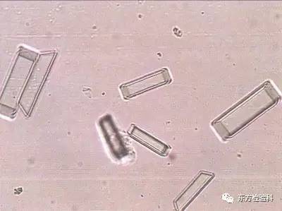 尿中结晶达到多少就是结石了,尿结晶数高是病吗