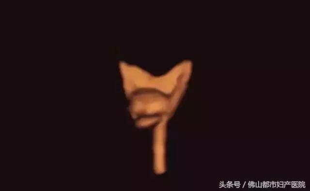 输卵管四维超声造影，不孕患者的福音