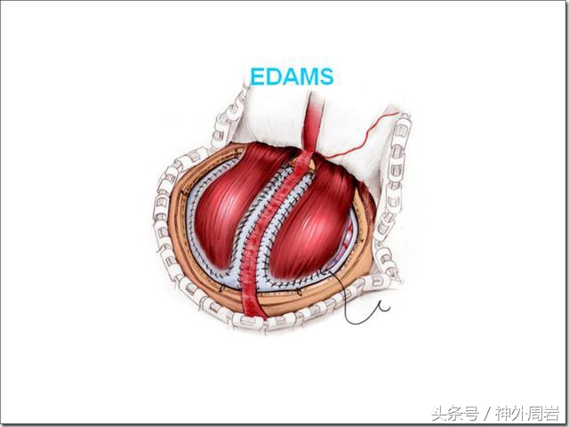 烟雾病脑内出血,烟雾病脑室出血死亡率