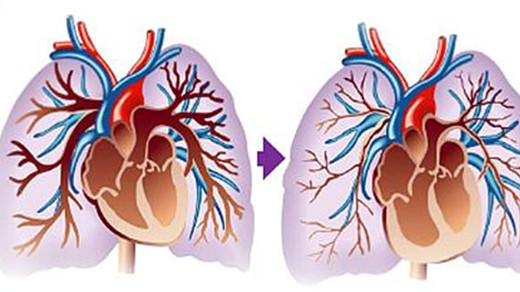 肺动脉高压能活几年呢,肺动脉高压重度动完手术能活几年