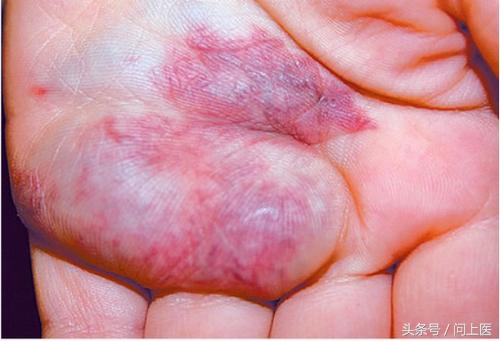 你有胎记吗？图解8种常见胎记