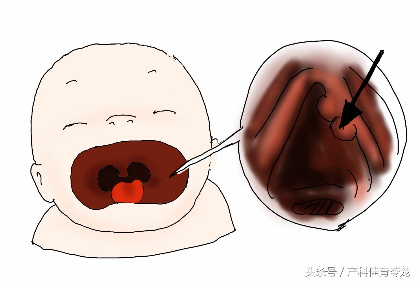 妊娠感染了hpv16,如果怀孕感染hpv怎么办