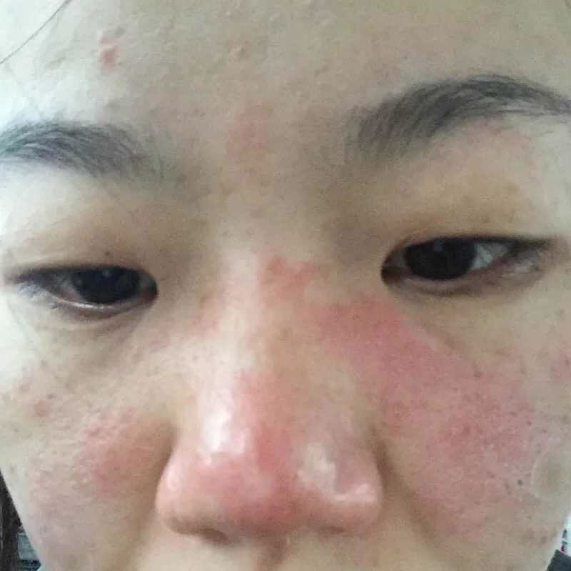 慎入！春季多发激素脸！你还要不要脸？