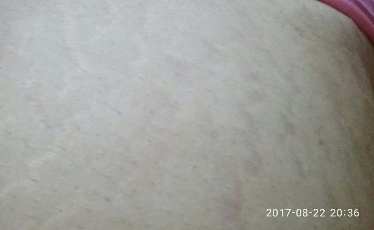 肥胖纹怎么消除产后,肥胖纹怎么消除涂什么药