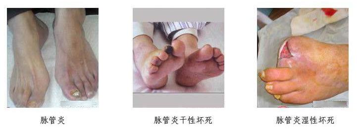 男子抽20年烟三根脚趾坏死,男子抽烟20年脚趾坏死