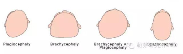 宝宝偏头莫担忧预防纠正有妙招,宝宝偏头的最佳治疗方法