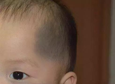 省̥妇̥幼̥专家提醒，宝宝出生有这些印记，一定要去！医！院！