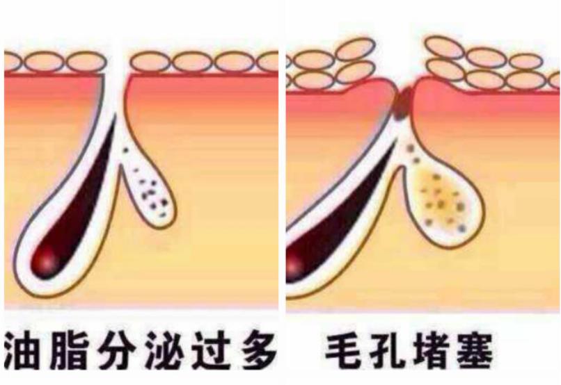 毛孔大怎么改善真的可以收缩毛孔,毛孔粗大怎么改善效果好