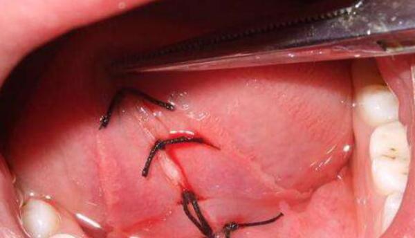 孩子的舌头是w型,宝宝的舌头是w型的应该挂什么科