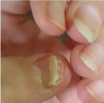 指甲上的月牙预示着什么,指甲上的月牙真的和健康有关系吗