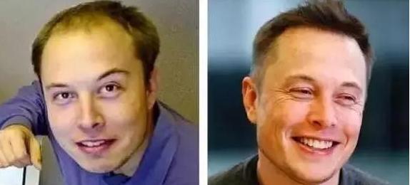 目前关于脱发的最新治疗方法,什么方法治疗脱发效果好