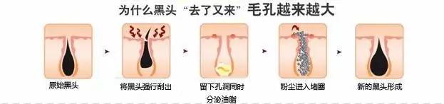 粉刺黑头去除最快方法,黑头虫怎么去除最快方法