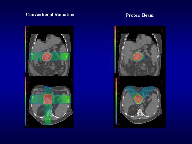 美国洛马林达质子治疗中心GaryYang：消化道肿瘤的质子放疗治疗