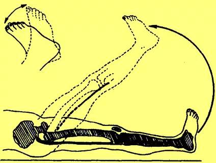 腰椎间盘突出根性症状临床表现,极外侧型腰椎间盘突出症临床表现