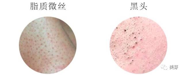 粉刺黑头去除最快方法,鼻子螨虫黑头怎么去除简单方法