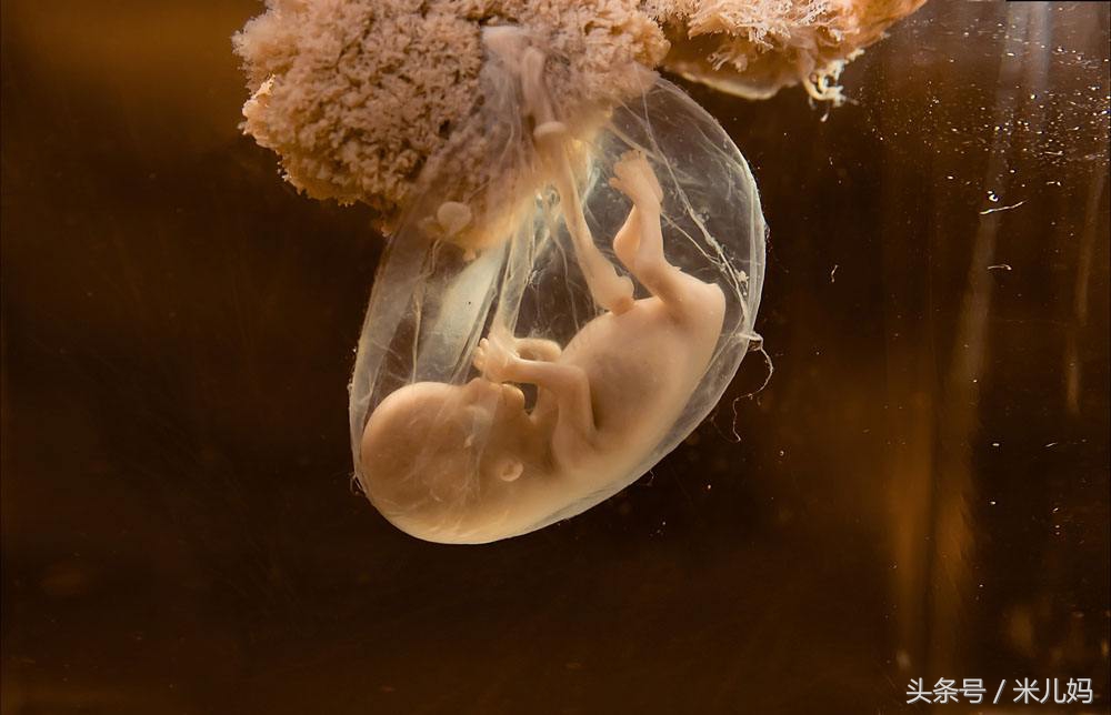 女孩医院做完流产，回家的路上大出血，孩子竟然还在肚子里