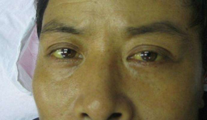 胰腺癌晚期腹痛怎么办,胰腺癌晚期黄疸腹痛