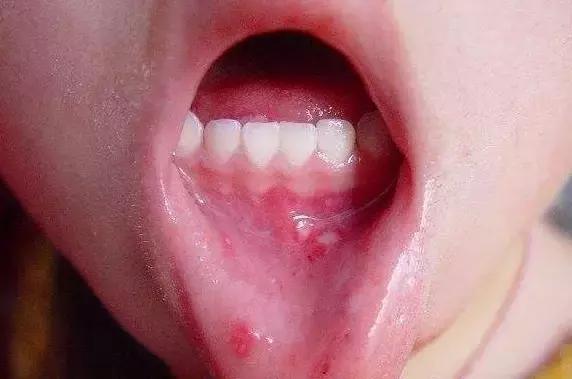 小孩常见的口腔问题如何治疗,小孩口腔各种疾病信号