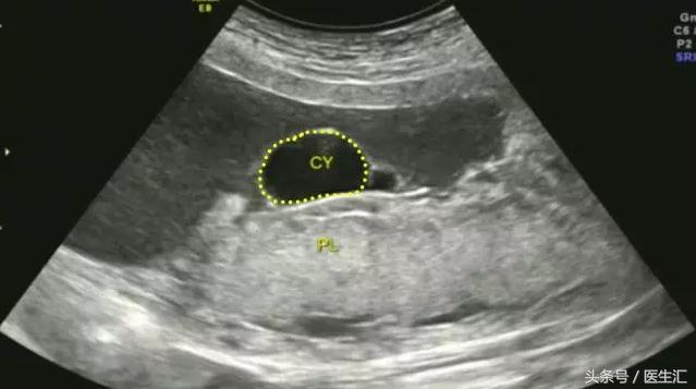 胎盘早剥诊断ppt,胎盘早剥的诊断与护理试题