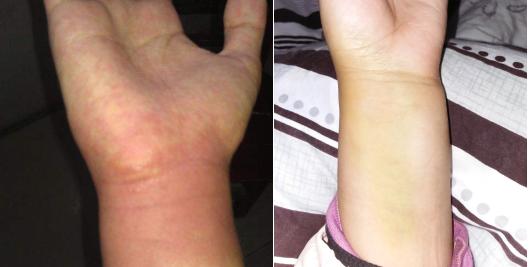 有过扭伤经历的人千万不能乱治我是被折磨惨了