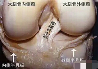 膝关节韧带损伤怎样好得快,膝关节韧带受伤怎么判断
