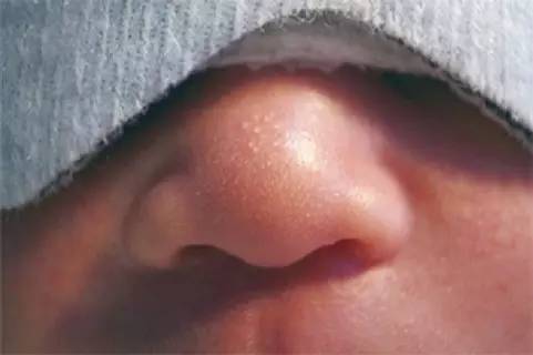 小月龄宝宝湿疹和热疹区别,宝宝粟粒疹和湿疹区别