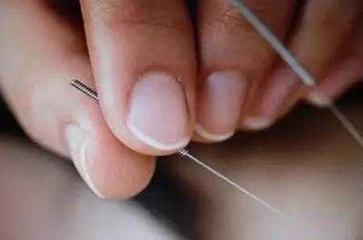 膝关节炎针灸五针疗法用何穴,膝关节炎的针灸治疗的穴位