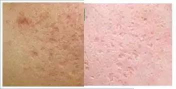 痘痘闭口摸起来还有点疼痛,痘痘闭口反反复复怎么办