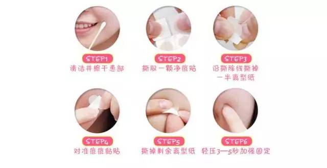 教你正确方法挤痘痘不留疤痕,正确挤痘痘的方法简单不用护肤品