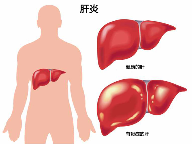 肝炎可分为,肝炎不同类型