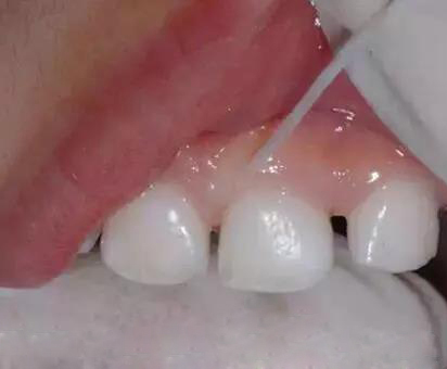 牙齿缝隙有黑的怎样去掉,幼儿的牙齿有黑污垢怎么去掉