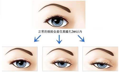 大小眼属于五官畸形吗,引起眼歪斜的所有原因