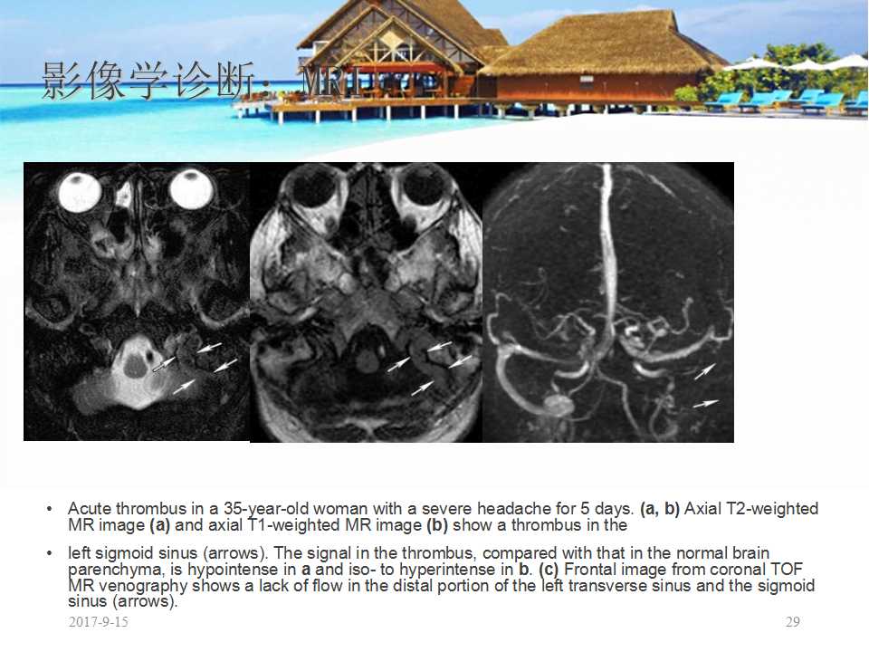 颅内静脉窦血栓形成怎么治疗,颅内静脉窦血栓怎么治疗