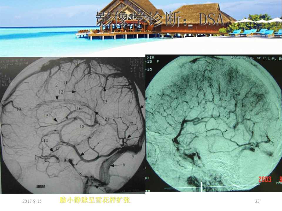 颅内静脉窦血栓形成怎么治疗,颅内静脉窦血栓形成最佳治疗方法