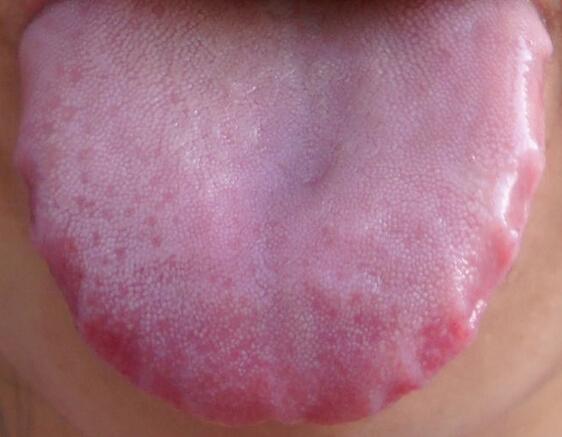 湿气重怎么办最快最有效的办法,湿气重怎么办一个小方法轻松搞定