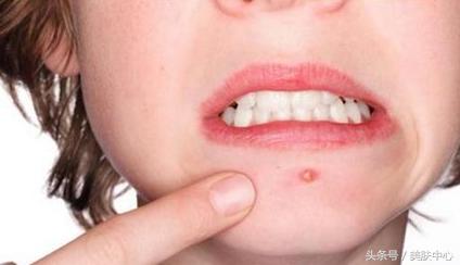 如何去掉下巴的痘痘痕迹,长期下巴痘痘去除小妙招