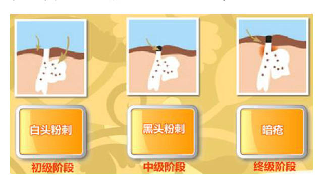 皮肤暗疮处理,暗疮痘痘的正确消除方式