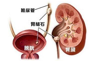 肾结石最好最安全的治疗方法,肾结石输尿管中段能体外碎结石吗