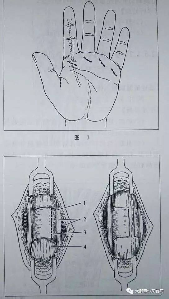 没有扣过扳机的你却得了“扳机指”？