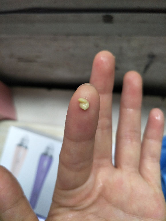 嘴里长石头是什么原因引起的,嘴里有石头会导致口臭吗