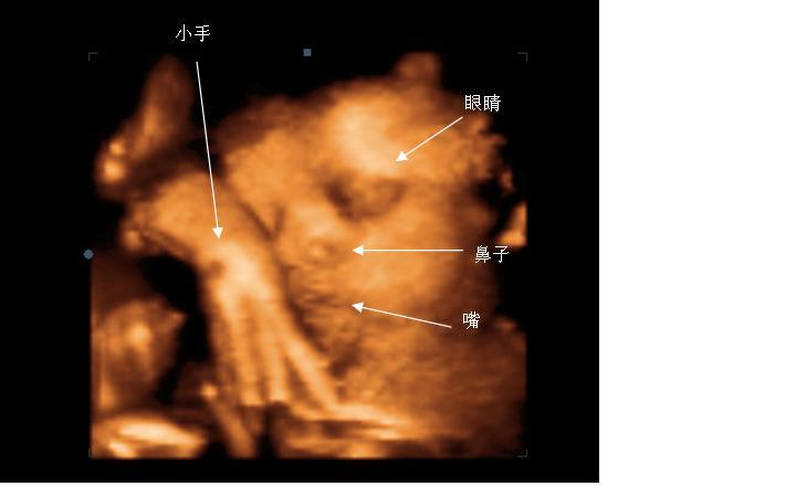 三维彩超和四维彩超区别,四维彩超大排畸和三维彩超的区别